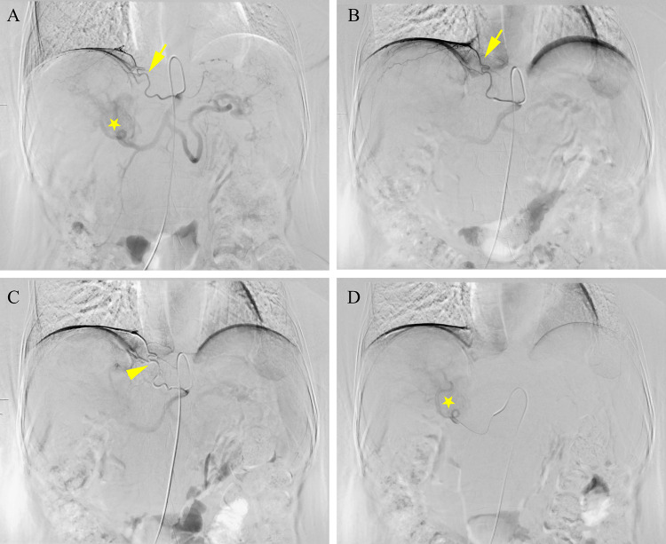 Efficacy and Safety of the Multi-Level Comprehensive Collateral Artery Embolism Sequential Hepatic Arterial Infusion Chemotherapy, Combined with TKI and ICI, for Unresectable Huge Hepatocellular Carcinoma (>10cm): A Propensity Score Matching Cohort Study.
