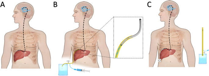 Analysis of the effect of laparoscopic temporary long-tunneled external ventricular drainage in patients with post-traumatic brain injury hydrocephalus.