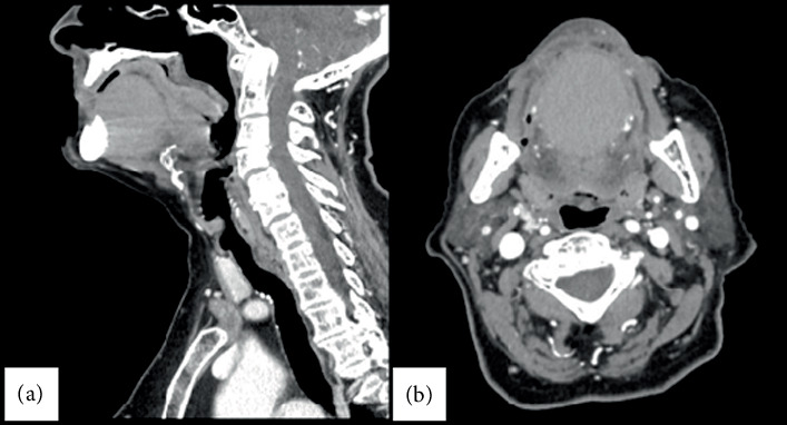 Oral Dermoid Cyst in the Mouth Floor: A Case Report and 5-Year Review of the Literature.