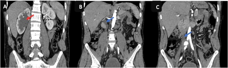 A rare etiology of right lower back pain in a young man: contained rupture of the common iliac artery aneurysm.