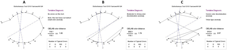 Color Vision in Schoolchildren with Low Birth Weight and Those Born Full-Term with Appropriate Weight for Gestational Age.