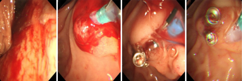 Vascular anomaly as a cause of late bleeding after endoscopic retrograde cholangiopancreatography: A case report.
