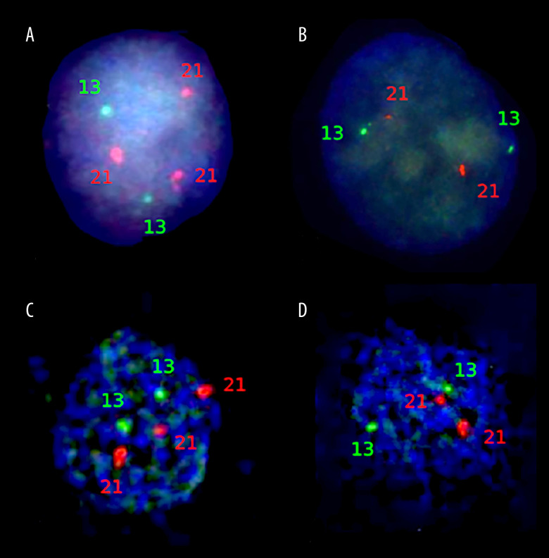Comprehensive Cytogenetic Analysis Reveals Mosaicism in Newborn with Negative Prenatal Down Syndrome Screening: A Case Report.