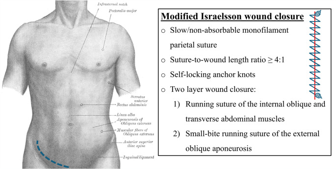Prediction of incisional hernia after kidney transplantation: analysis of wound closure technique and risk factors.