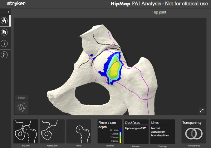Contemporary Techniques in Femoral Osteoplasty.