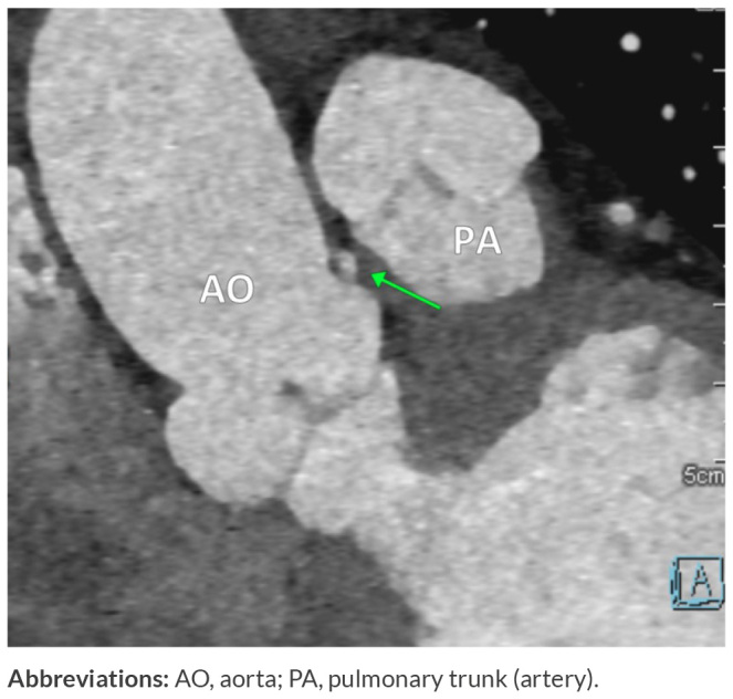 Anomalous Origin of the Right Coronary Artery from the Left Main Coronary Artery in A Patient with Non-Specific Chest Pain.