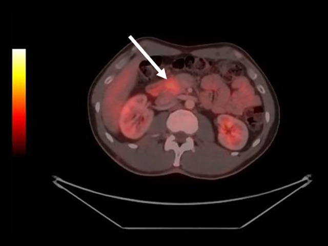 Pancreatic Inflammation Induced by Immune Checkpoint Inhibitors in Melanoma Treatment: A Case Report.