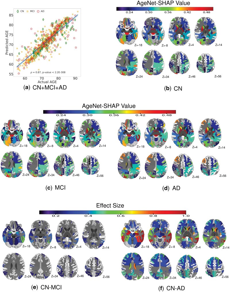An explainable AI approach for mapping multivariate regional brain age and clinical severity patterns in Alzheimer's disease.