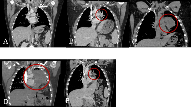 Use of PULSAR (personalized ultra-fractionated stereotactic adaptive radiotherapy) as consolidation with immune checkpoint inhibition in the treatment of pediatric metastatic melanoma.