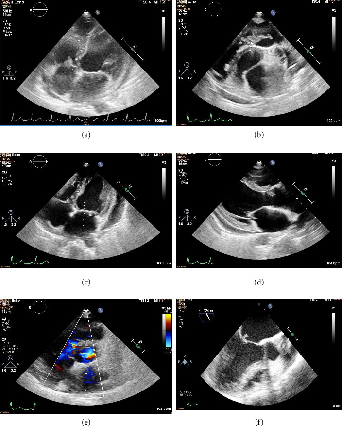 A Rare Case of Quadrivalvular Infective Endocarditis.