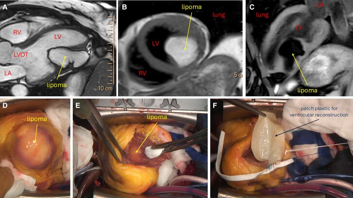 Successful resection of a large asymptomatic lipoma in the left ventricle with infiltration of the myocardial free wall: a case report.