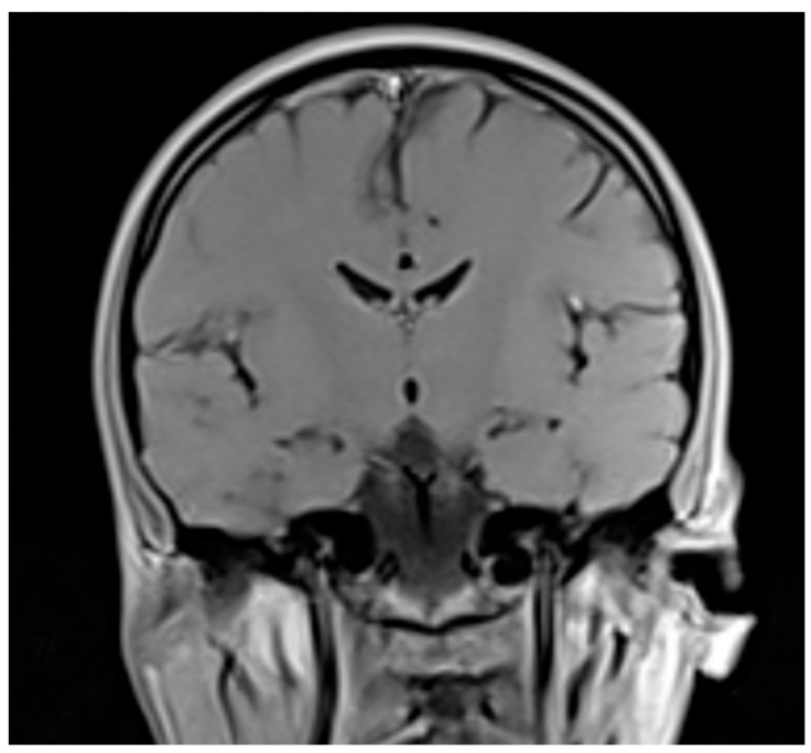 Catatonia in a Possible Case of Moderate Neuroleptic Malignant Syndrome: A Case Report.