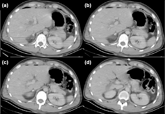 Tangential gunshot injury of the right portal vein branch resulting in subacute main portal vein thrombosis: Successful treatment without hepatectomy