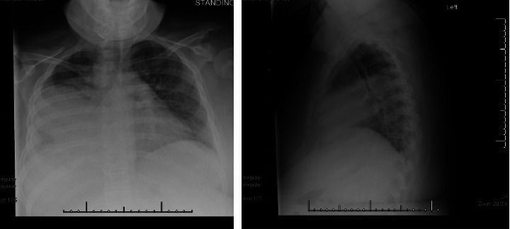 Siblings in the ICU: Keeping Endemic Mycoses on the Differential.