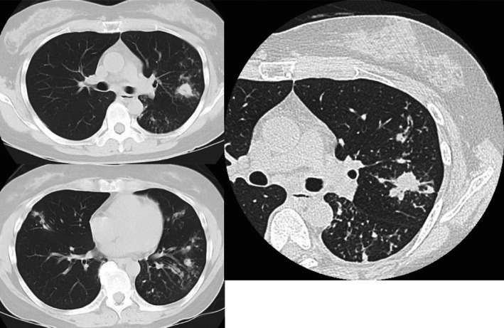 Tracheobronchial Tuberculosis During Treatment for Bronchial Asthma.