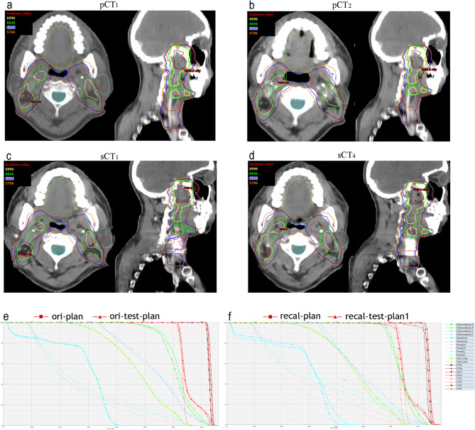 Nasopharyngeal cancer adaptive radiotherapy with CBCT-derived synthetic CT: deep learning-based auto-segmentation precision and dose calculation consistency on a C-Arm linac.