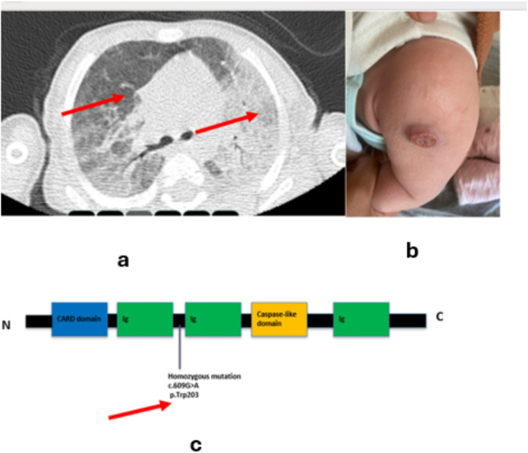 To The Editor a Novel Mutation in MALT1 Deficiency.