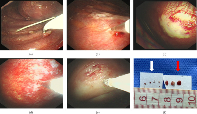 Cryobiopsy as a Salvage Technique Following Negative Flexible Forceps Biopsy of the Pleura Under Rapid On-Site Evaluation Guidance: A Prospective Study.