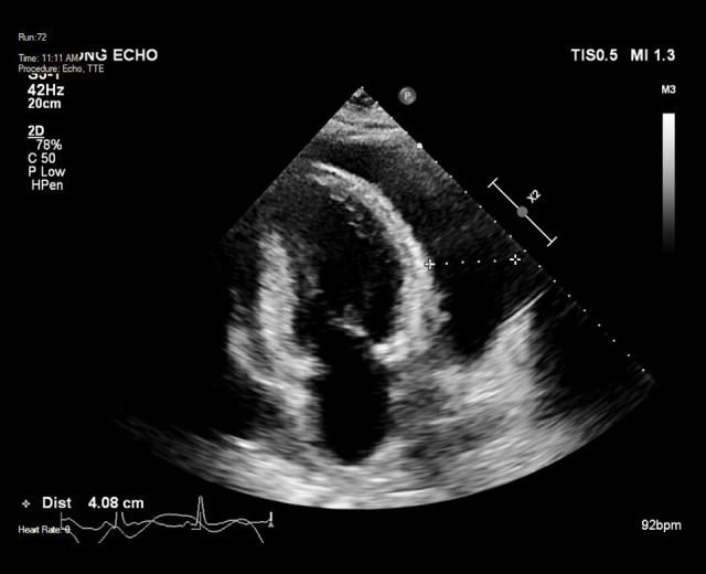 Management of Cardiac Tamponade During Systemic Lupus Erythematosus Flare with Significant Pericardial Effusion: A Case Report.