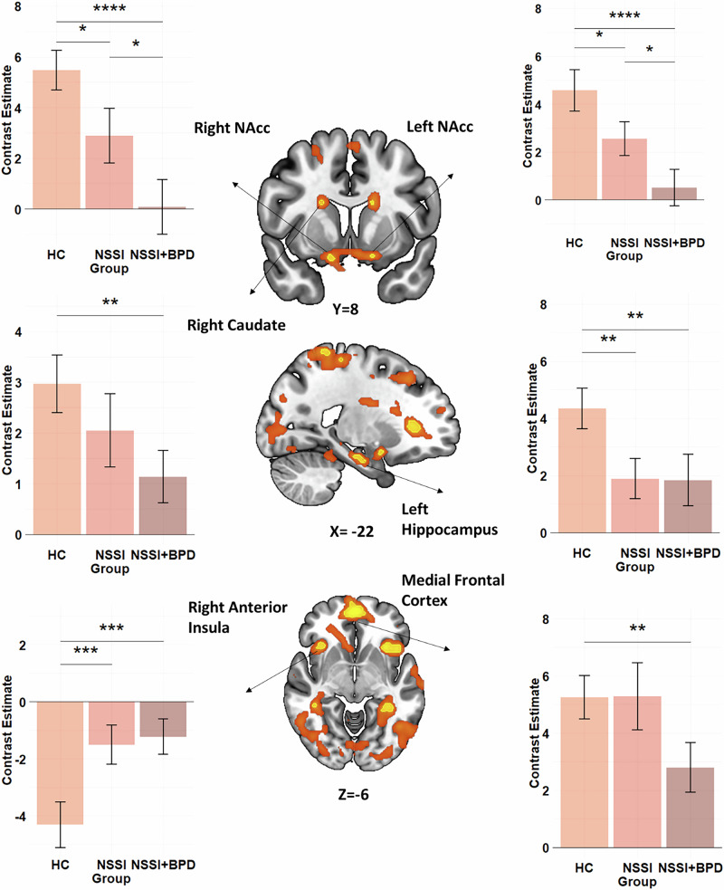 Reward-related neural activation during social media exposure in young women with non-suicidal self-injury: evidence for a continuum of severity in the reward network.