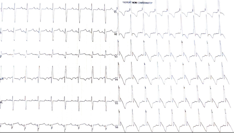 An uncommon case of neonatal asphyxia associated with infantile-onset Pompe disease.