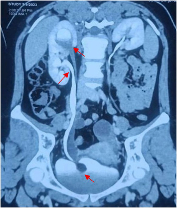 Endoscopic thulium-fiber laser deroofing and dual stenting for adult duplex ureterocele with preserved upper renal moiety: a case report.