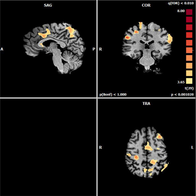 Distinct neural circuits processing pleasant and unpleasant sounds: an fMRI-based approach.