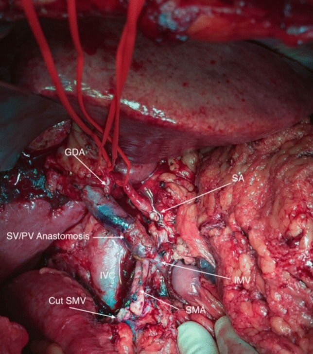 Redirecting venous flow from the superior mesenteric vein to the inferior mesenteric vein in resections for locally advanced pancreatic cancer.