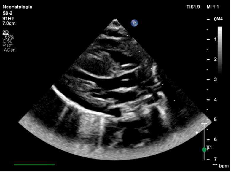 An uncommon case of neonatal asphyxia associated with infantile-onset Pompe disease.