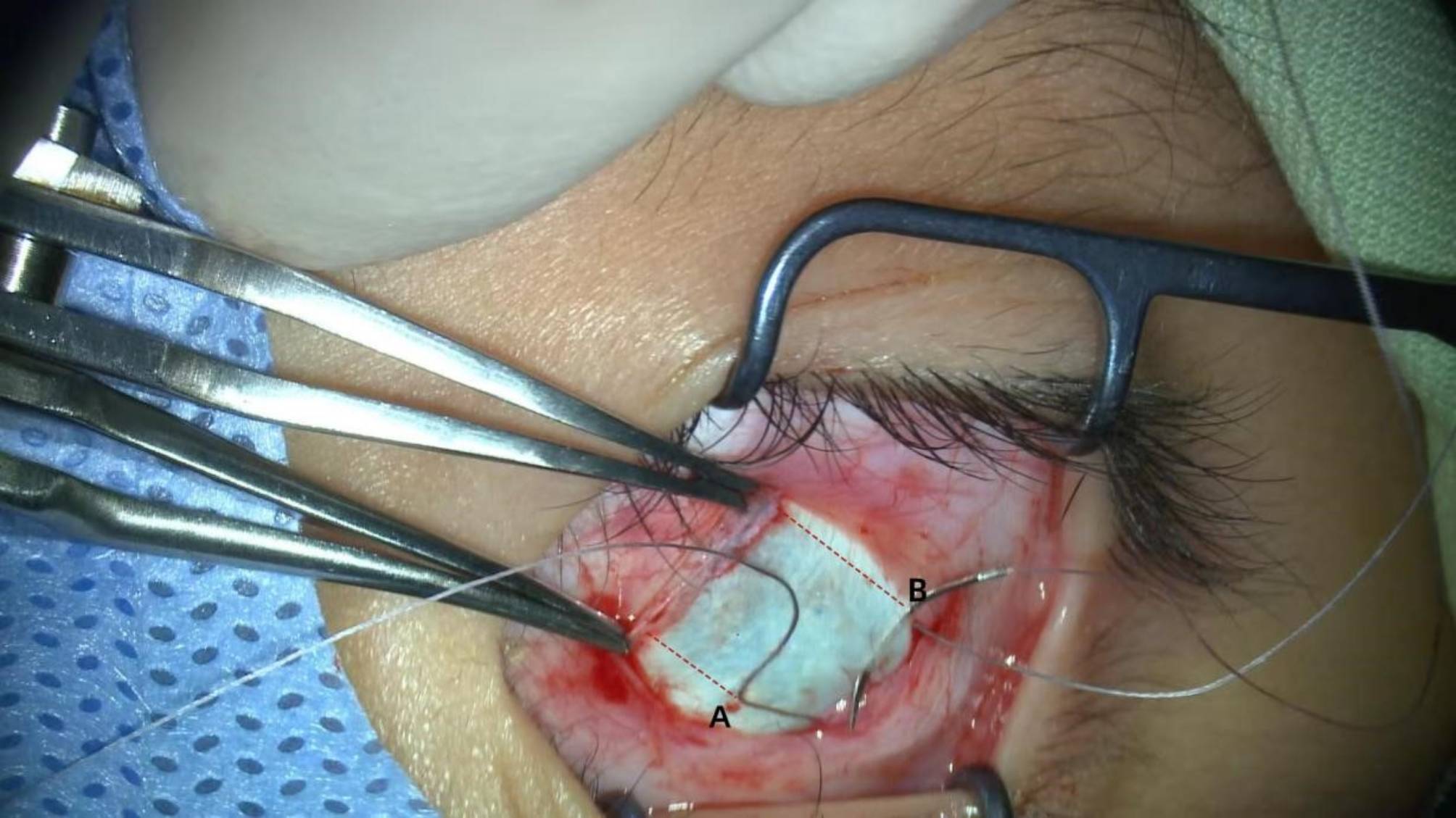 Impact of slanted lateral rectus recession on pediatric patients with convergence insufficiency intermittent exotropia.