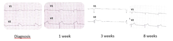 Brugada ECG Pattern in A Caucasian Patient with Severe Hypothyroidism.