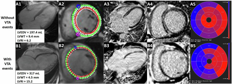 Left ventricular remodeling index to predict ventricular tachyarrhythmia in dilated cardiomyopathy with ejection fraction < 35.