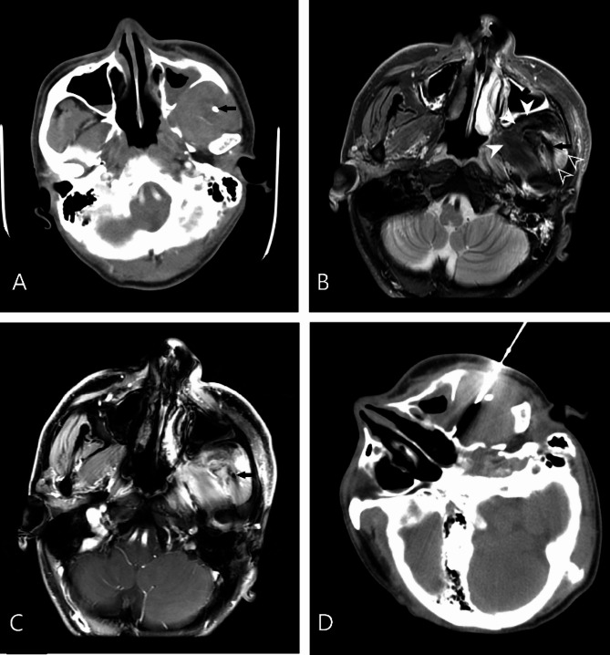 A percutaneous core needle biopsy of deep suprahyoid head and neck lesions with CT-guided: study of diagnostic performance and factors associated with diagnostic failure.