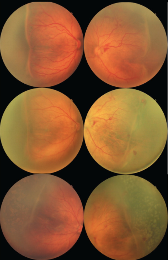 Effect of Ranibizumab in Patients with Treatment-Naïve Retinopathy of Prematurity.