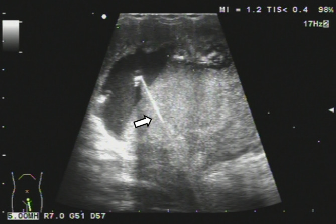 Migration of a urethral foreign body into the scrotum in an adolescent: a case report.