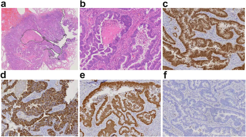 Solitary pulmonary metastasis with cystic airspaces in colon cancer: A rare case report.