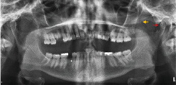Suspected Posttraumatic Mandibular Coronoid Hyperplasia and Condylar Hypoplasia: Two Case Reports and Literature Review.
