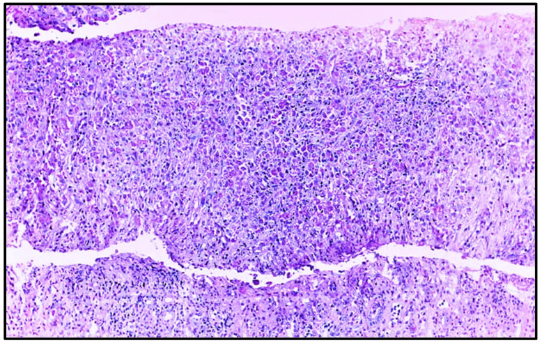 Renal Malacoplakia Following Obstetric Intervention: A Rare Cause of Acute Kidney Injury in a Young Woman.