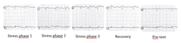Brugada ECG Pattern in A Caucasian Patient with Severe Hypothyroidism.
