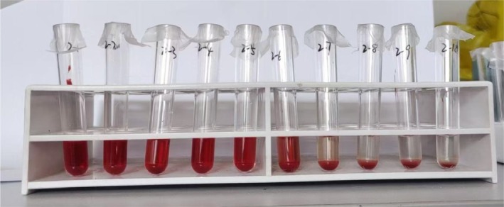 The impact of pressure and temperature on the quality of suspended red blood cells: An ex vivo simulation study.
