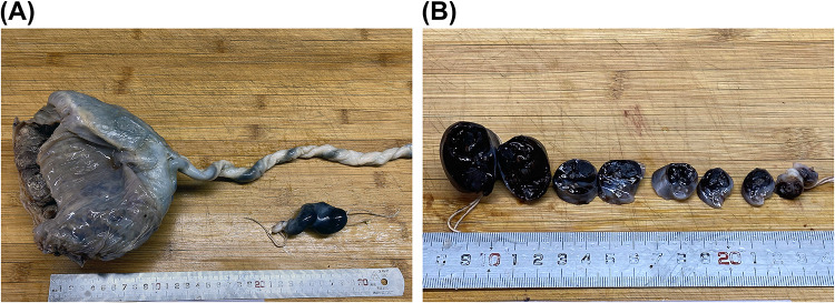 Fatal Umbilical Cord Hemorrhage Triggering Neonatal Demise: Clinicopathological Insights from the Case Analysis.