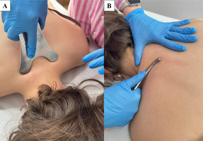 Instrument-assisted soft tissue mobilization and percussion massage therapy in cervical disc herniation: a randomized controlled study.