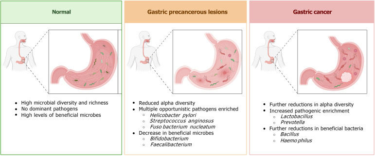 Gastrointestinal microbiota in treatment of gastric precancerous lesions and gastric cancer by Western and traditional Chinese medicine.