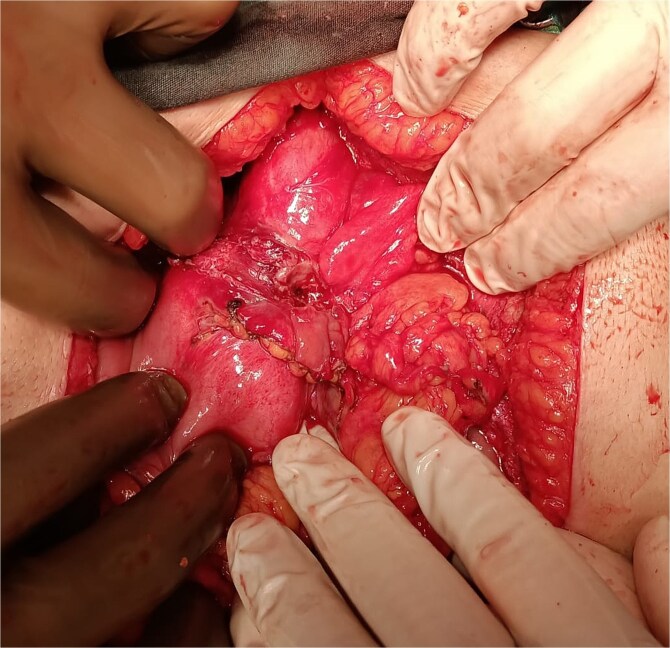Alternative approach of complicated peptic ulcer perforation in recurrent and delayed-two cases.