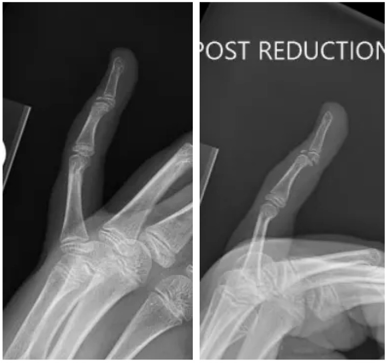 Open Reduction and Internal Fixation of a Volar Displaced Salter-Harris III Mallet Fracture in a Pediatric Patient: A Case Report.
