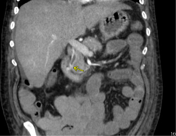 Hemostasis With Fully Covered Self-Expanding Bare Metal Stent as a Bridge to Liver Transplantation in a Patient With Acute Liver Failure and Hemodynamically Unstable Hemobilia.