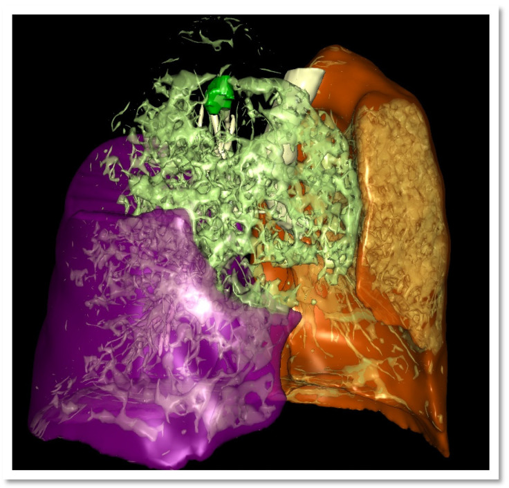 Estimating Postoperative Lung Function Using Three-Dimensional Segmental HRCT-Reconstruction: A Retrospective Pilot Study on Right Upper Lobe Resections.