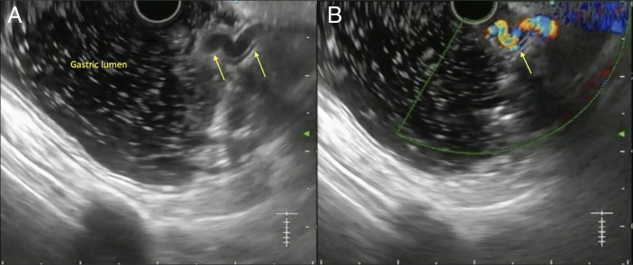 Expanding Horizons of Vascular Interventions: Endoscopic Ultrasound-Guided Angioembolization for a Refractory Upper Gastrointestinal Bleed From a Gastric Dieulafoy Lesion.