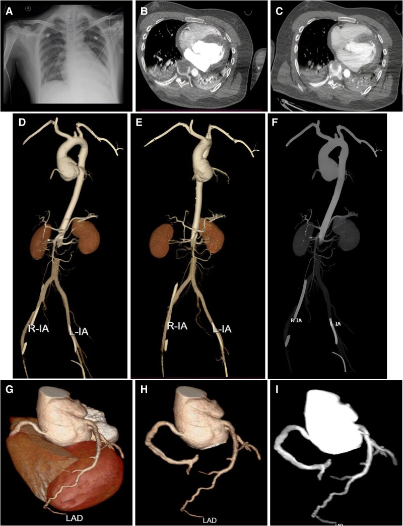 Computed tomography angiography diagnosis of Marfan syndrome complicated with fulminant myocarditis under extracorporeal membrane oxygenation support: a case report.