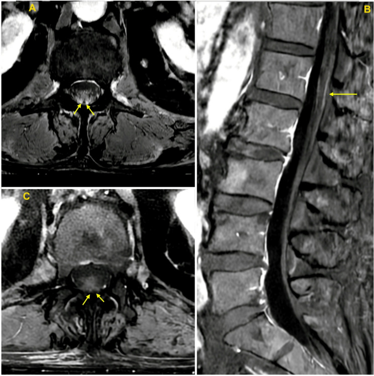 Cauda equina nerve root enhancement in adult intestinal toxemia botulism.